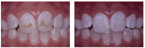 Manchas superficiales causadas por fluorosis