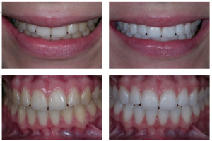 Resultados antes y después del blanqueamiento dental casero